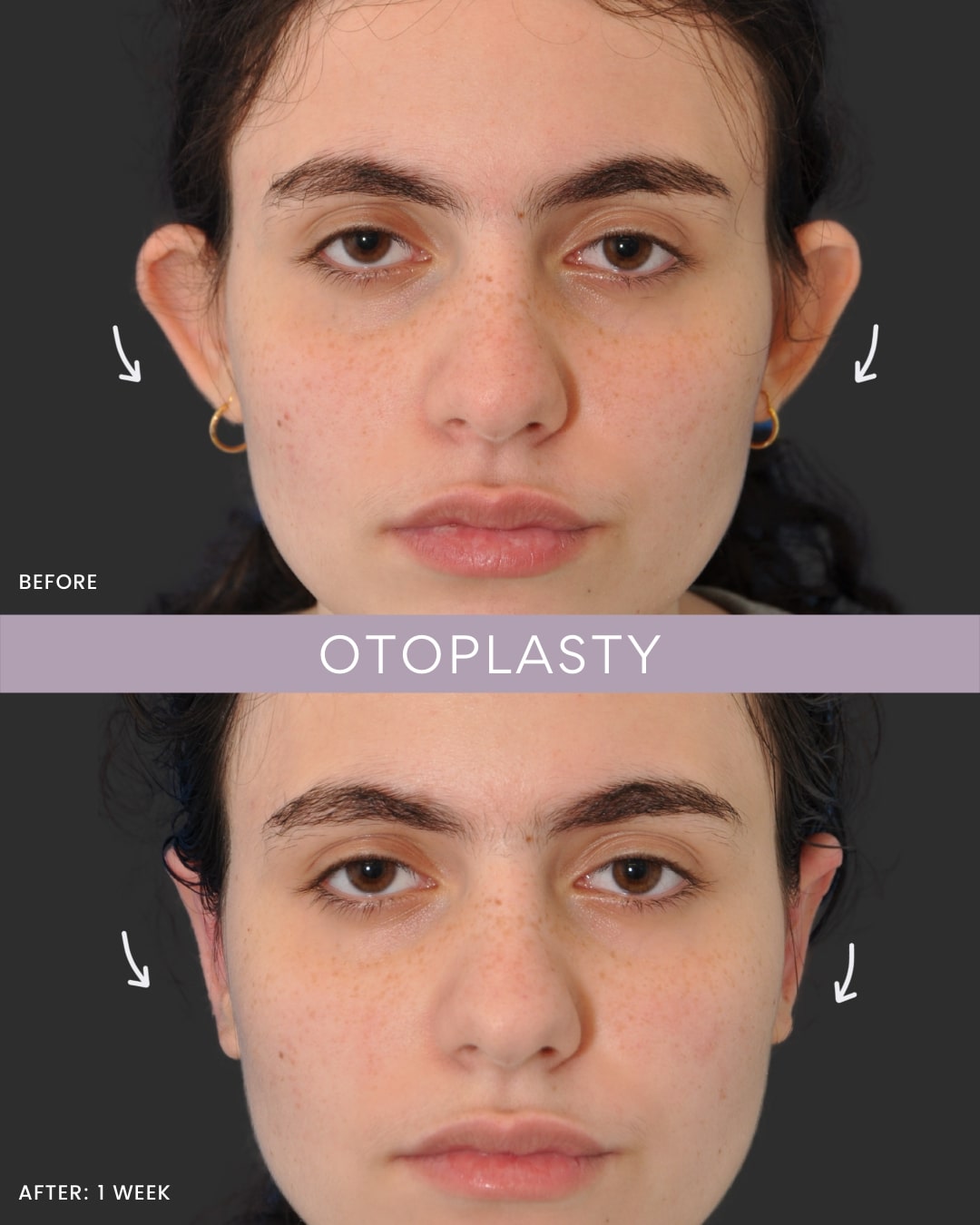 before and after of otoplasty surgery