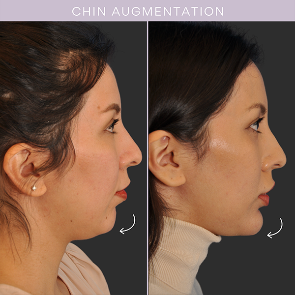 Chin Augmentation Before & After Pictures