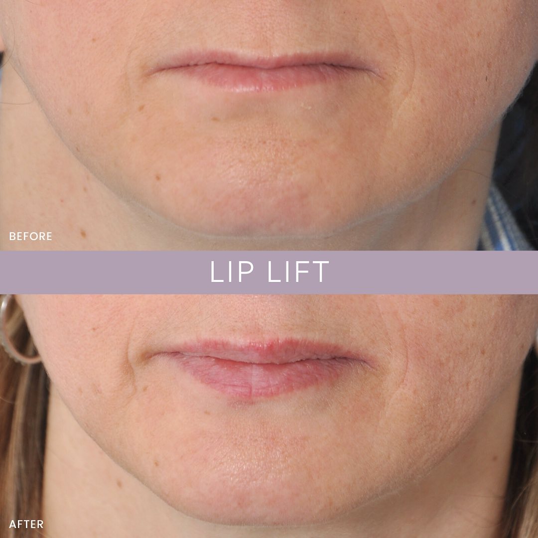 Lip Lift NYC Lip Specialist New York