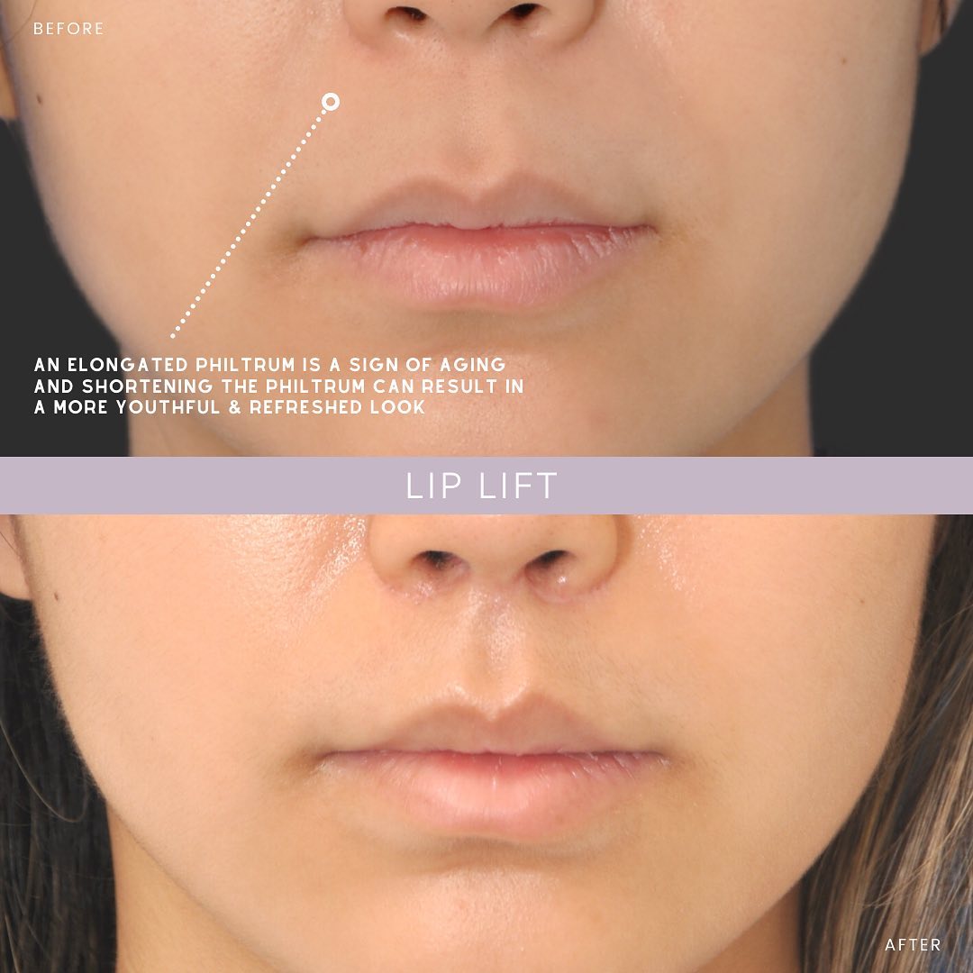 Lip Lift NYC Lip Specialist New York