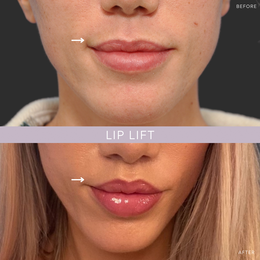 Non surgical lip lift deals