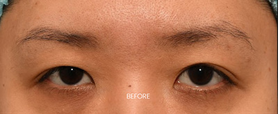 Before Rhinoplasty in NYC Nose Surgery NYC