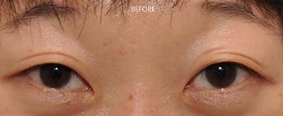 Before Nose Surgery New York Nose Surgery New York