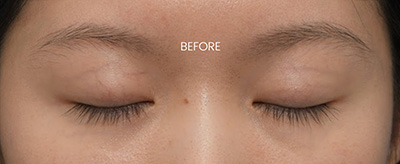 Before Nose Job NYC Rhinoplasty New York