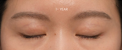 After Nose Job NYC Rhinoplasty NYC