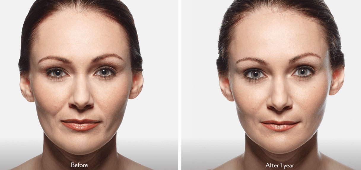 Dermal Fillers NYC Facial Fillers New York City