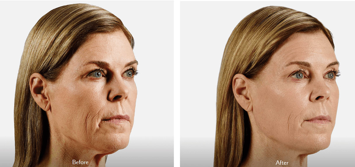 Dermal Fillers NYC Facial Fillers New York City