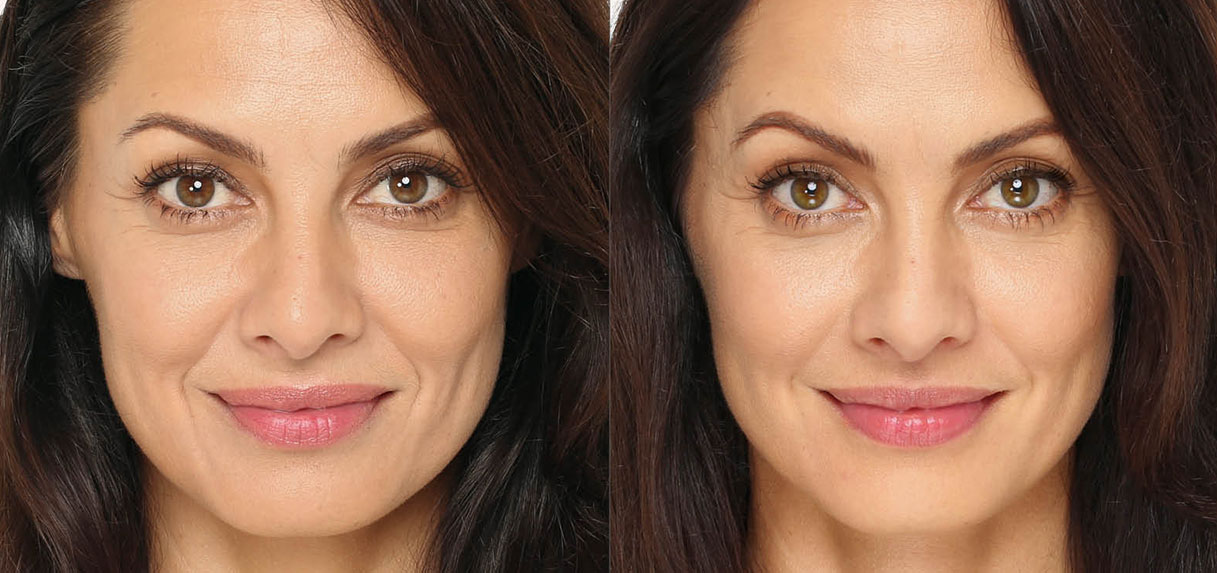 Dermal Fillers NYC Facial Fillers New York City