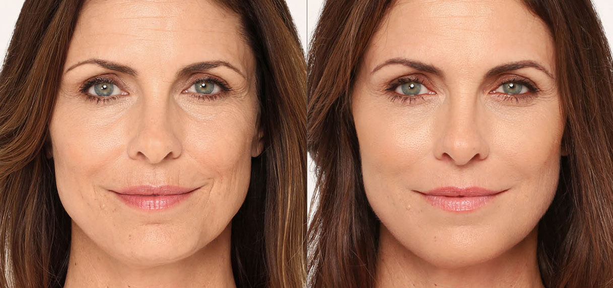 Dermal Fillers NYC Facial Fillers New York City