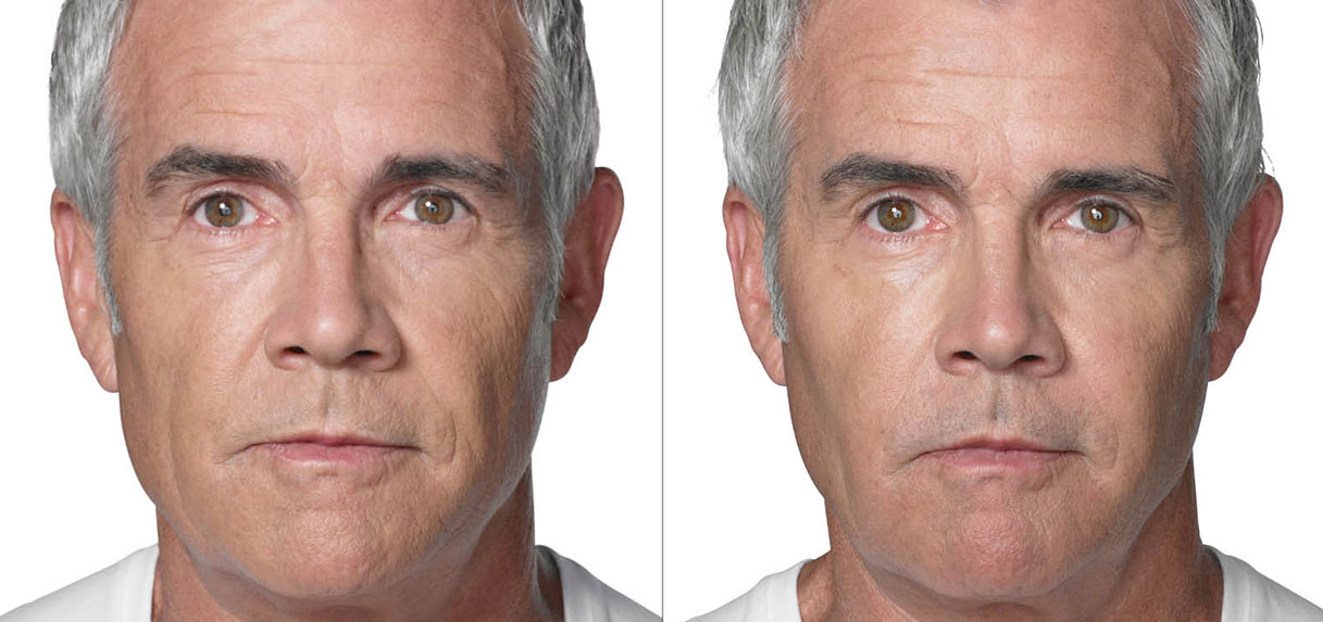What's the difference between Profhilo and fillers? - Glowday
