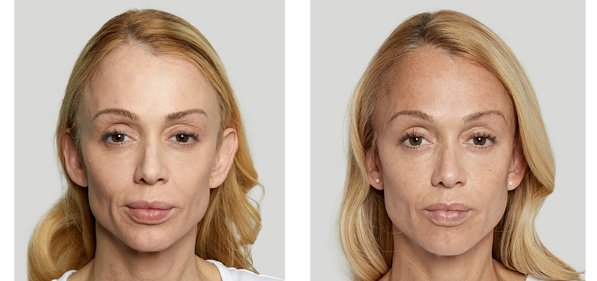 Dermal Fillers NYC Facial Fillers New York City