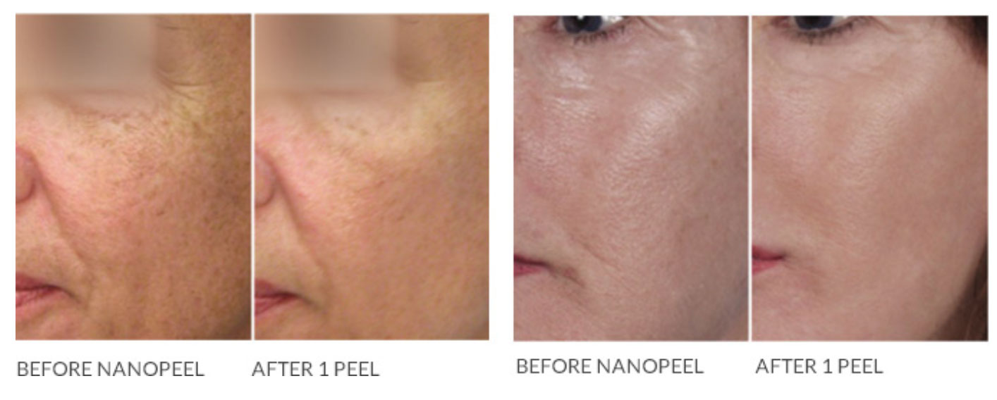 Before and After
