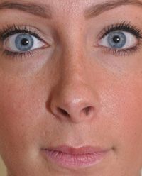 Revision Rhinoplasty NYC | Before