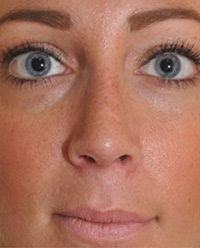 Revision Rhinoplasty New York | After